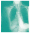 ¿La TB afecta sólo los pulmones?