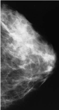 An Example of a Normal Mammogram