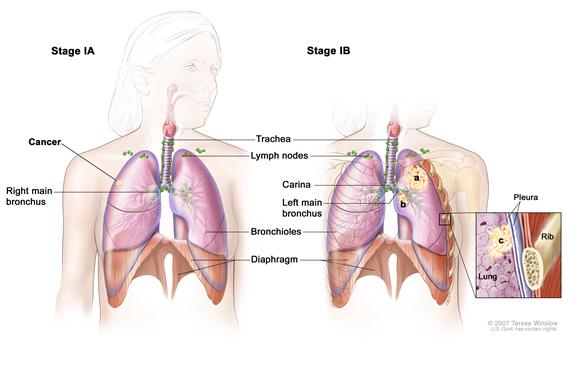 Two-panel drawing of stage I non-small cell lung cancer; first panel shows stage IA with cancer in one lung; the trachea, lungs, lymph nodes, right main bronchus, bronchioles, and diaphragm are also shown; second panel shows stage IB with cancer in the left lung and near the left main bronchus. The inset shows a close-up of the lung, chest wall, and pleura with cancer spreading from the lung into the innermost layer of the pleura.