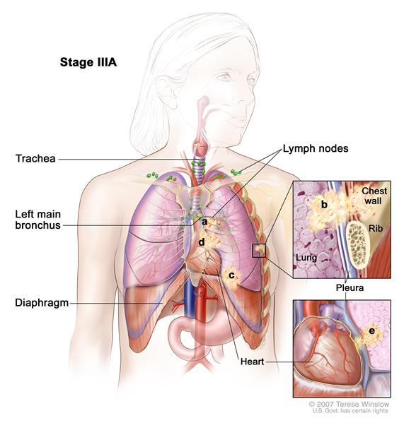 Stage IIIA non-small cell lung cancer; drawing shows cancer in the lymph nodes, the left main bronchus, pleura, diaphragm, and chest wall. One inset shows a close up of cancer spreading from the lung into the pleura and chest wall; another inset shows a close up of cancer spreading from the lung into the pericardium (membrane around the heart).
