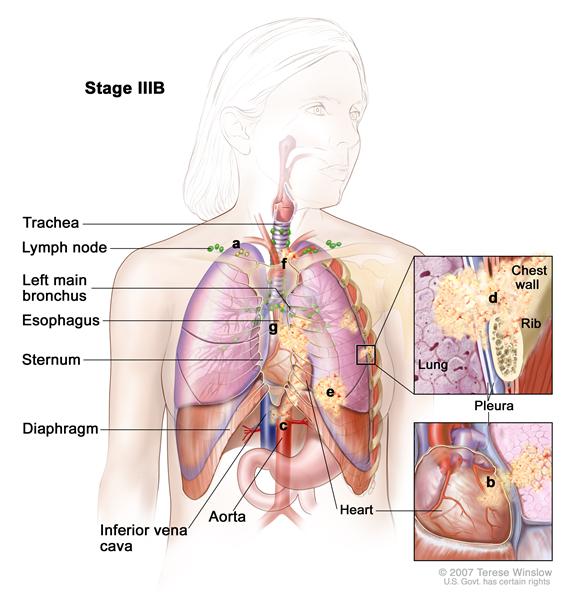 Stage IIIB non-small cell lung cancer; drawing shows cancer in the lymph nodes above the collarbone or lymph nodes in the opposite side of the chest from the cancer; also shows cancer in the trachea, left main bronchus, esophagus, sternum, diaphragm, inferior vena cava, aorta, heart, and chest wall. One inset shows a close-up of cancer spreading from the lung into the pleura and chest wall; another inset shows a close-up of cancer spreading from the lung into the pericardium (membrane around the heart) and the heart.