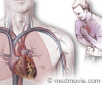 Angina Illustration