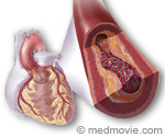 Coronary Artery Disease Illustration