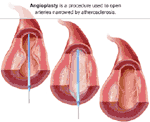 Angioplasty Illustration