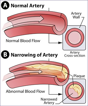 Picture of a normal artery with normal blood flow (Figure A) and an artery with plaque (Figure B).