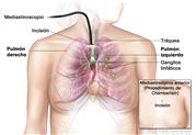 Mediastinoscopía; muestra el mediastinoscopio con luz y lentes insertado en el pecho mediante una incisión en la parte superior del esternón.  El dibujo muestra el pulmón derecho e izquierdo, la tráquea y los ganglios linfáticos.  El recuadro muestra la mediastinoscopía anterior (Procedimiento de Chamberlain) con una incisión al lado del esternón.