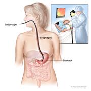 Upper endoscopy; shows endoscope inserted through the mouth and esophagus and into the stomach. Inset shows patient on table having an upper endoscopy.