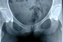 an xray image of a human female's pelvis.