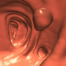 an image produced using virtual colonoscopy technology.