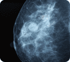 Photo of an x-ray of a woman's breast
