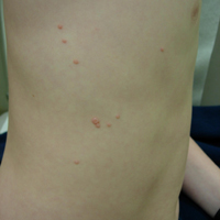 Typical molluscum lesions on the torso of a child. Typical lesions areapproximately 3-5 mm in diameter.