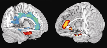 photo of MRI brain scans