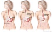 Un dibujo en tres paneles muestra la cirugía del cáncer esofágico; el primer panel muestra el área del esófago con cáncer, el panel del centro muestra la extirpación del cáncer y el tejido circundante, y el último panel muestra como se estira el estómago y se une al resto del esófago.