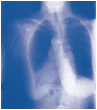 Análisis de laboratorio de fluidos o tejido de los pulmones.