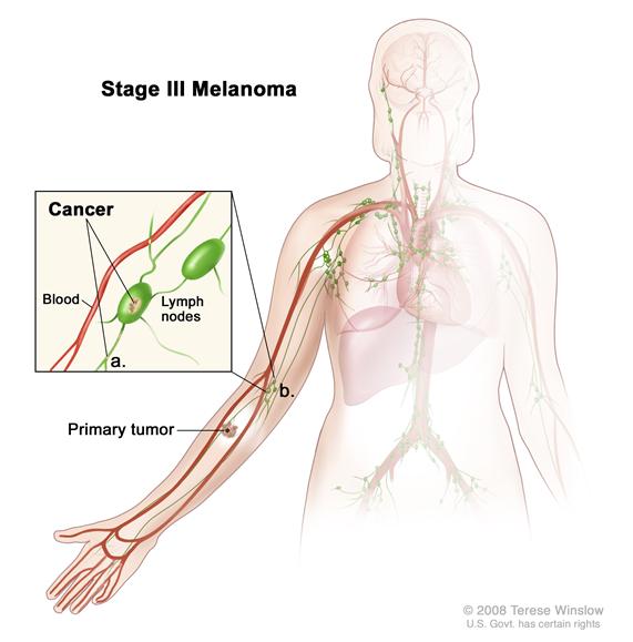 Stage III melanoma; drawing shows a primary tumor on the lower arm. Cancer is also shown in lymph nodes in the armpit region. The pullout shows cancer in a lymph node and lymph vessels in the arm near the tumors.