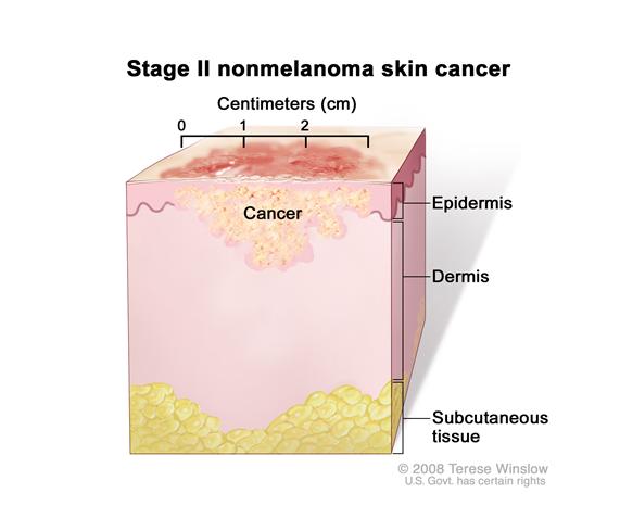Stage II nonmelanoma skin cancer; drawing shows a tumor that is more than 2 centimeters wide that has spread from the epidermis (outer layer of the skin) into the dermis (inner layer of the skin). Also shown is the subcutaneous tissue below the dermis.
