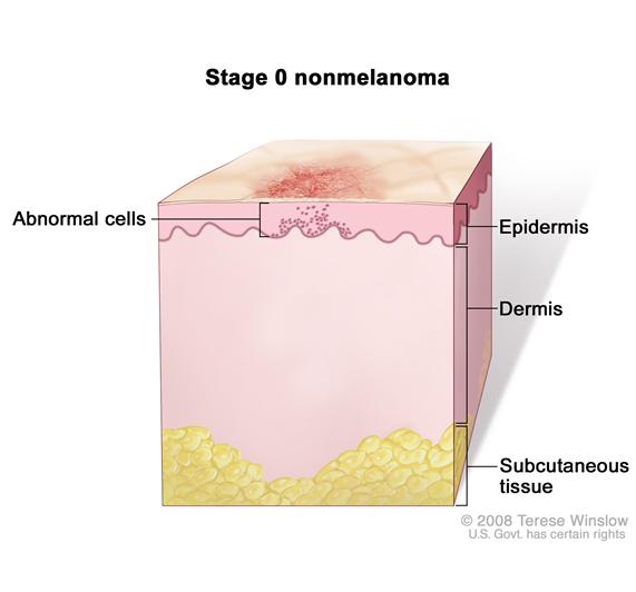 Stage 0 nonmelanoma; drawing shows skin anatomy with abnormal cells in the epidermis (outer layer of the skin). Also shown are the dermis (inner layer of the skin) and subcutaneous tissue below the dermis.