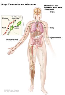Stage IV nonmelanoma skin cancer; drawing shows that the primary tumor has spread to other places in the body, such as the brain or lung. The pullout shows cancer in the lymph nodes, lymph vessels, and blood vessel in the arm with the primary tumor.