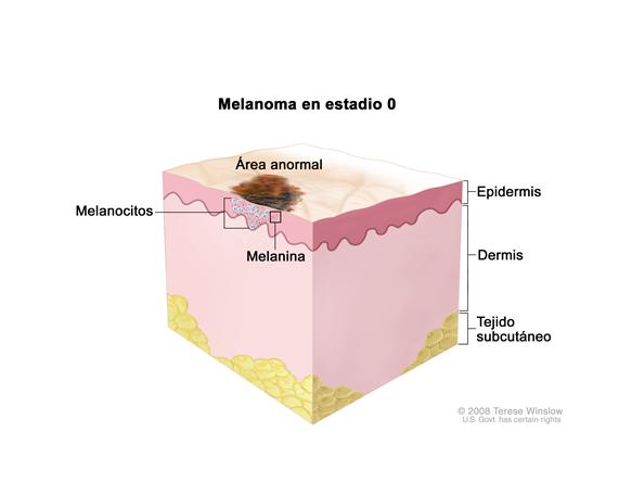 Melanoma en estadio 0; el dibujo muestra la anatomía de la piel con un área anormal en la superficie de esta. Se muestra la epidermis (capa exterior de la piel) con melanocitos y melanina normales y anormales. También se muestra la dermis (capa interna de la piel) y el tejido subcutáneo bajo la dermis.