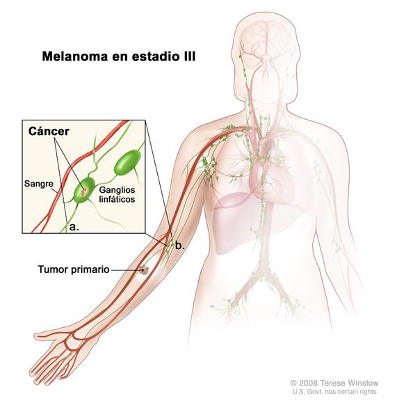 Melanoma en estadio III; el dibujo muestra un tumor primario en la parte más baja del brazo.  También se muestra el cáncer en los ganglios linfáticos en la región axilar.  La ampliación muestra el cáncer en un ganglio linfático y en los vasos linfáticos del brazo cerca de los tumores.
