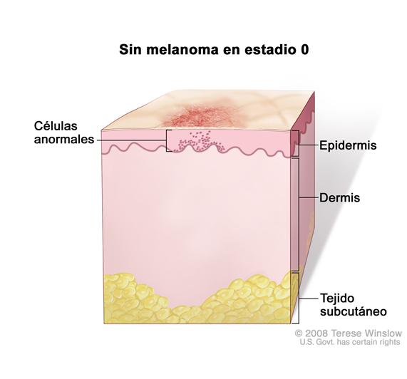 Sin melanoma en estadio 0; el dibujo muestra la anatomía de la piel con células anormales en la epidermis (capa externa de la piel). También se muestra la dermis (capa interna de la piel) y el tejido subcutáneo debajo de la dermis.