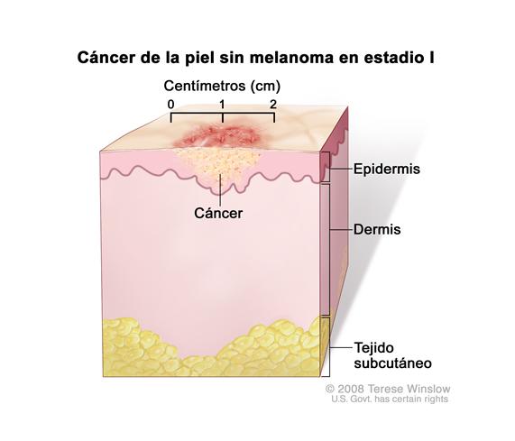 Cáncer de la piel sin melanoma en estadio I; el dibujo muestra un tumor en la epidermis (capa externa de la piel) que mide dos centímetros o menos de ancho. También se muestra la dermis (capa interna de la piel) y el tejido subcutáneo debajo de la dermis.