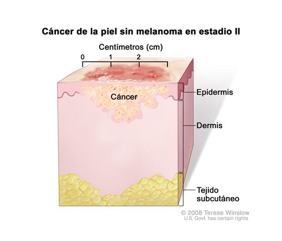 Cáncer de la piel sin melanoma en estadio II; el dibujo muestra un tumor que mide más de dos centímetros de ancho y que se ha diseminado desde la epidermis (capa externa de la piel) hacia la dermis (capa interna de la piel). También muestra el tejido subcutáneo debajo de la dermis.