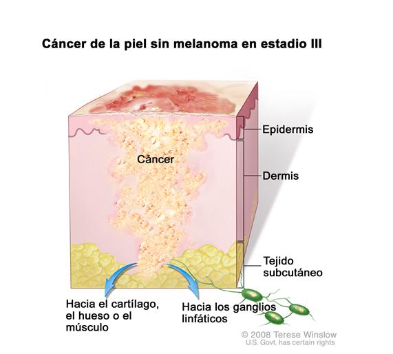 Cáncer de la piel sin melanoma en estadio III; el dibujo muestra un tumor que se ha diseminado desde la epidermis (capa externa de la piel) y la dermis (capa interna de la piel) hacia el tejido subcutáneo y hacia el cartílago, el hueso o el músculo debajo de la piel o hacia los ganglios linfáticos cercanos.