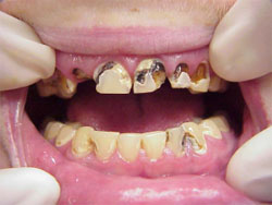 Photo of a Meth Mouth