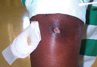A MRSA skin abscess on a man's knee
