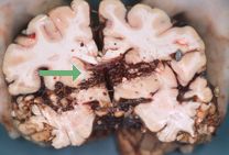 Photograph of the brain section showing the bullet track and projectile