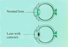 The image diagram (on top) shows what a normal lens of an eye looks like.  Underneath that, it shows an eye with a cataract on the lens.  The lens with the cataract appears considerably smaller than the normal lens.