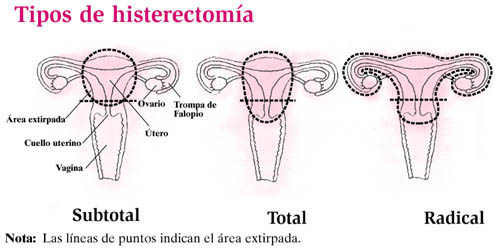 Tipos de Histerectomia