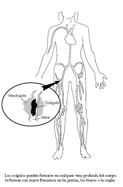 Figura 1: Ilustración de un coágulo de sangre. Para más detalles, diríjase a la descripción del texto que aparece abajo.