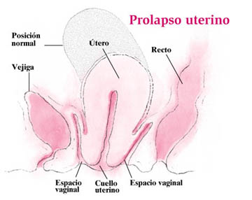 El Prolapso Uterino