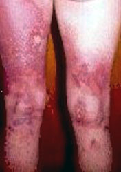 Thermal contact burn on a man's legs caused by clothing catching on fire where electric current exited his body