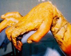 A worker's hand and wrist showing involuntary muscle contraction and mummified fingers resulting from electric shock