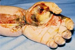 A worker's hand and forearm showing where the skin was cut open to relieve pressure caused by swelling from massive subcutaneous tissue damage resulting from electrical shock