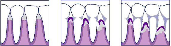 Diagrama de encías normales encías con peridontitis encías con peridontitis avanzada