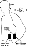 Coupling a cochlear implant to an ALS using a patch cord