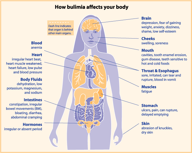 Diagram of how bulumia affect the body