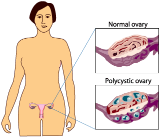 Normal Ovary and Polycystic Ovary