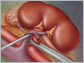 A depiction of the kidney as seen in a live donor transplant.
