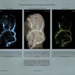 Cerebral Vasculature of Craniopagus Conjoined Twins