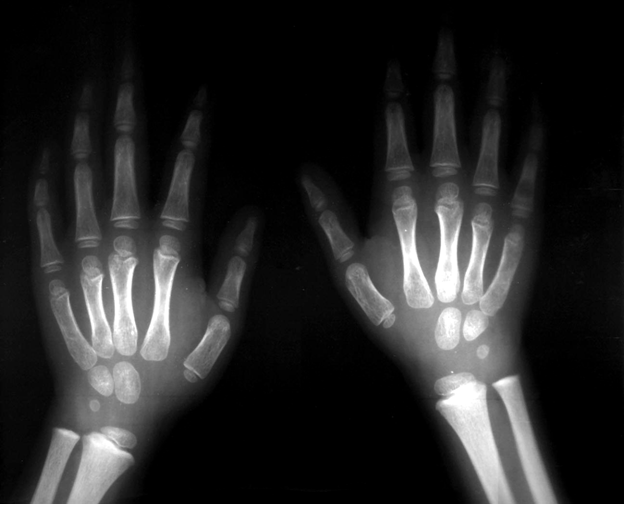 Radiografías de huesos largos en las manos. Líneas de plomo presentes en un niño de 5 años.