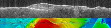 Bright Lower Echo in Radargram of South Polar Layered Deposits