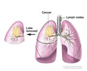 Lobectomy; drawing shows lobes of both lungs, trachea, bronchi, bronchioles, and lymph nodes. Cancer is shown in one lobe. The removed lobe is shown next to the lung from which it was removed.