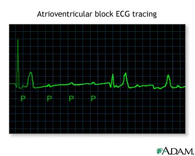 Atrioventricular block, EKG tracing