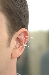 A close up of acupuncture needles applied to an ear.