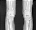 X-Ray of knees with osteoarthritis